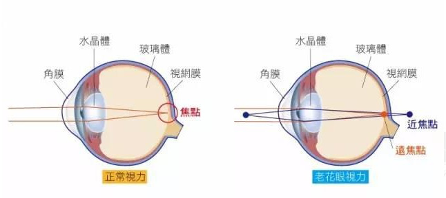 500度近視又老花，戴上美麗島多焦鏡煩惱全解決，46歲的周先生樂壞了